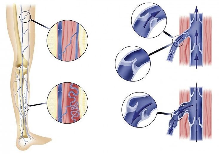 Veniselle restores blood flow